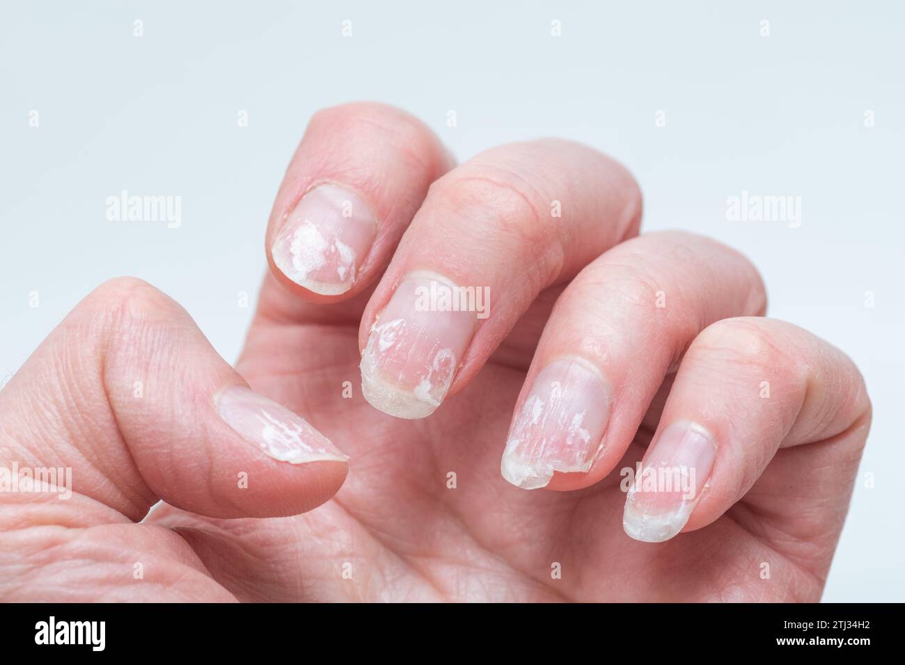 What can you do about yellow nails? | Ohio State Medical Center