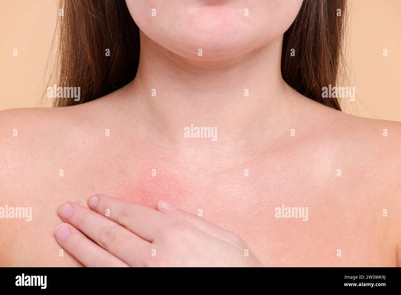 Closeup view of woman with reddened skin on her collarbone against beige background Stock Photo