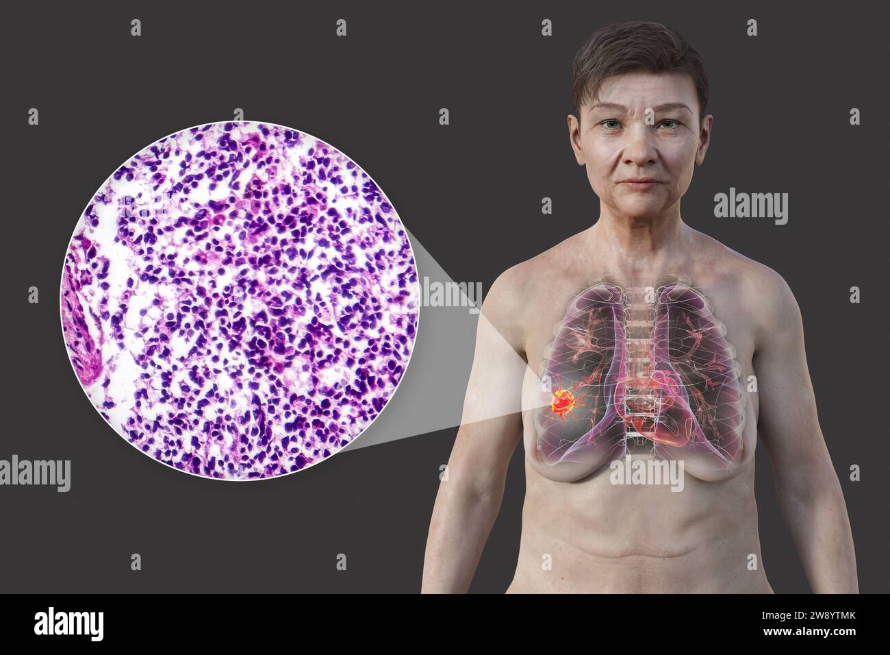 Woman with lung cancer, illustration Stock Photo