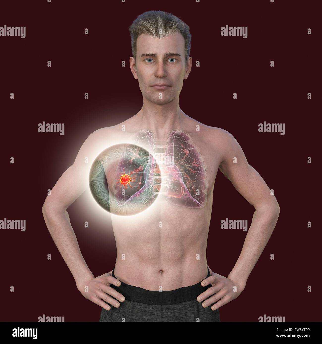 Man with lung cancer, illustration Stock Photo - Alamy