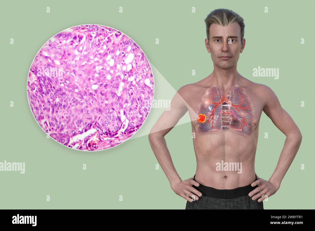 Man with lung cancer, illustration Stock Photo - Alamy