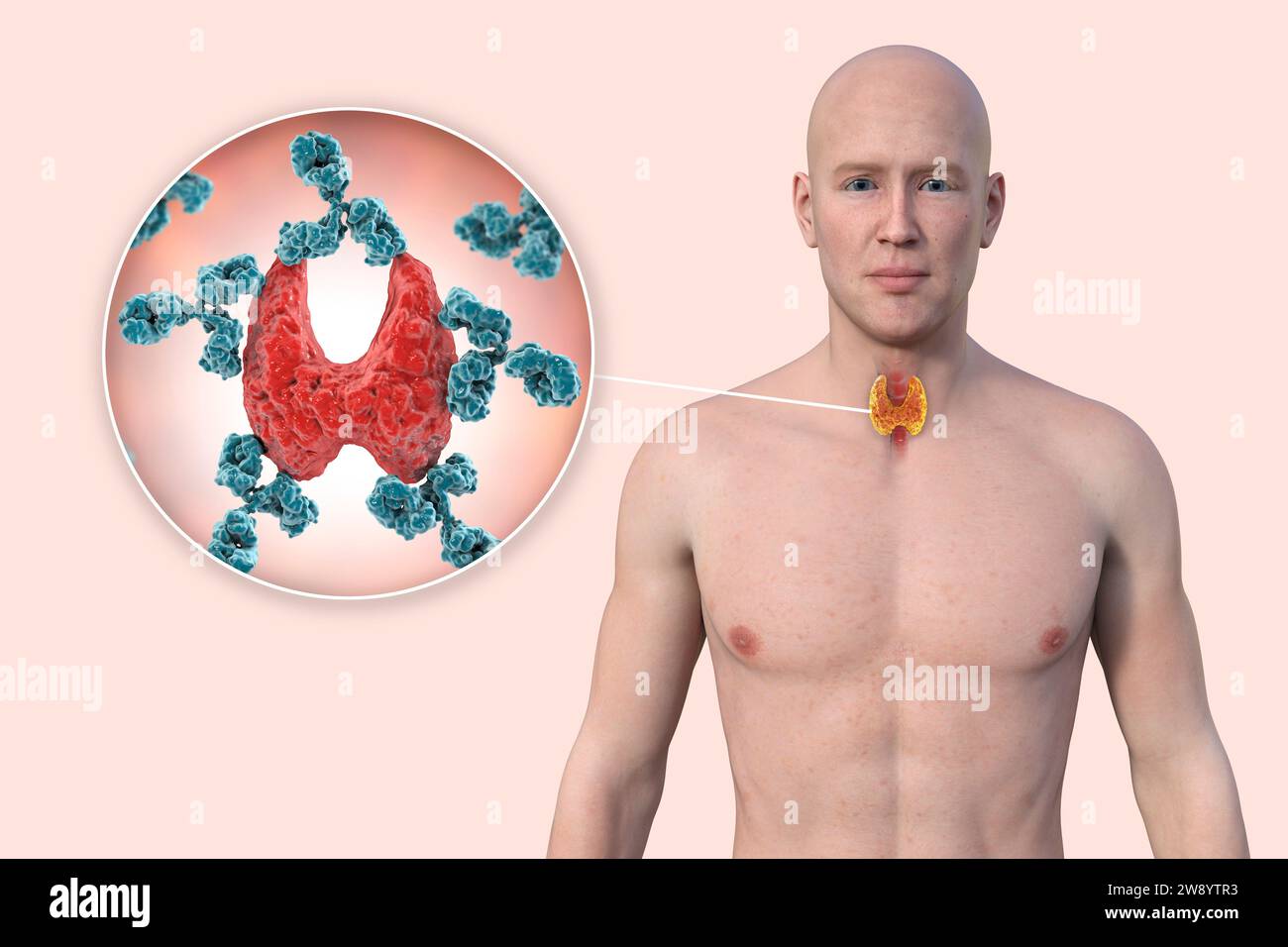 Illustration showing a man with autoimmune thyroiditis (Hashimoto's disease), revealing the