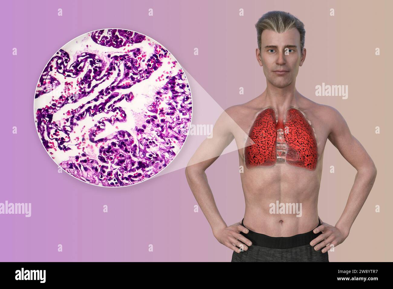 Man with smoker's lungs, illustration Stock Photo