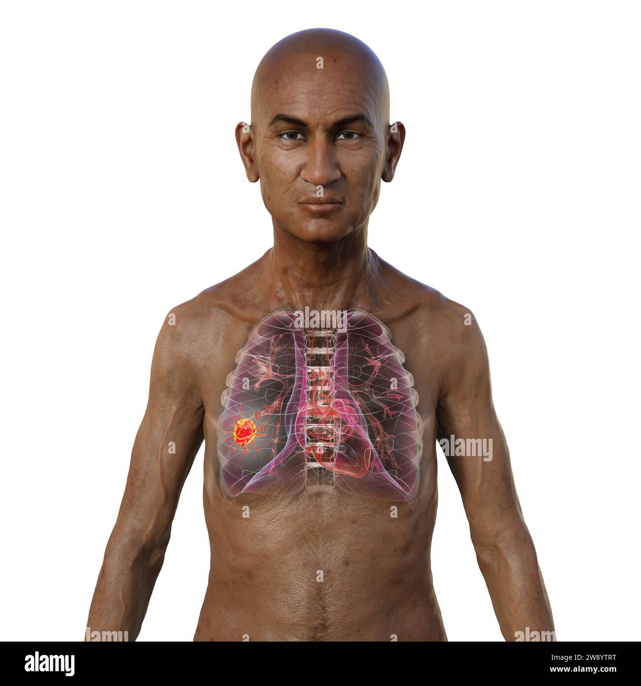 Man with lung cancer, illustration Stock Photo