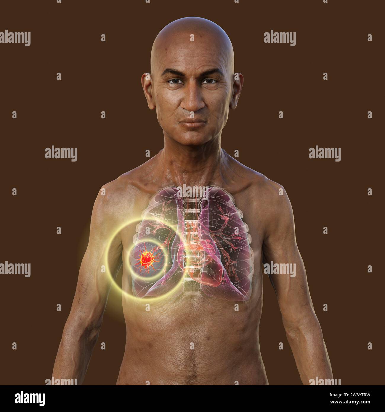 Man with lung cancer, illustration Stock Photo - Alamy