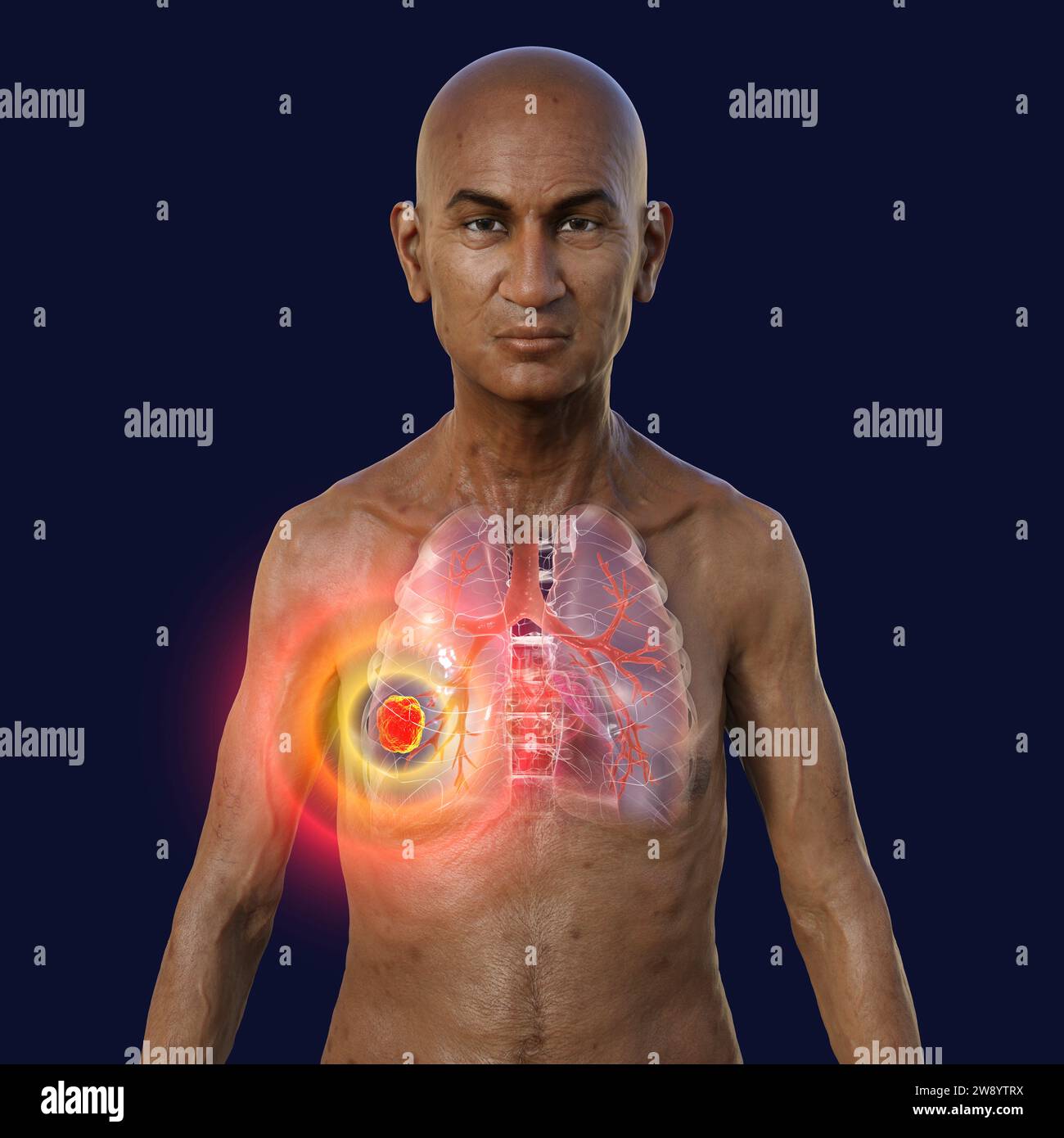 Man with lung cancer, illustration Stock Photo