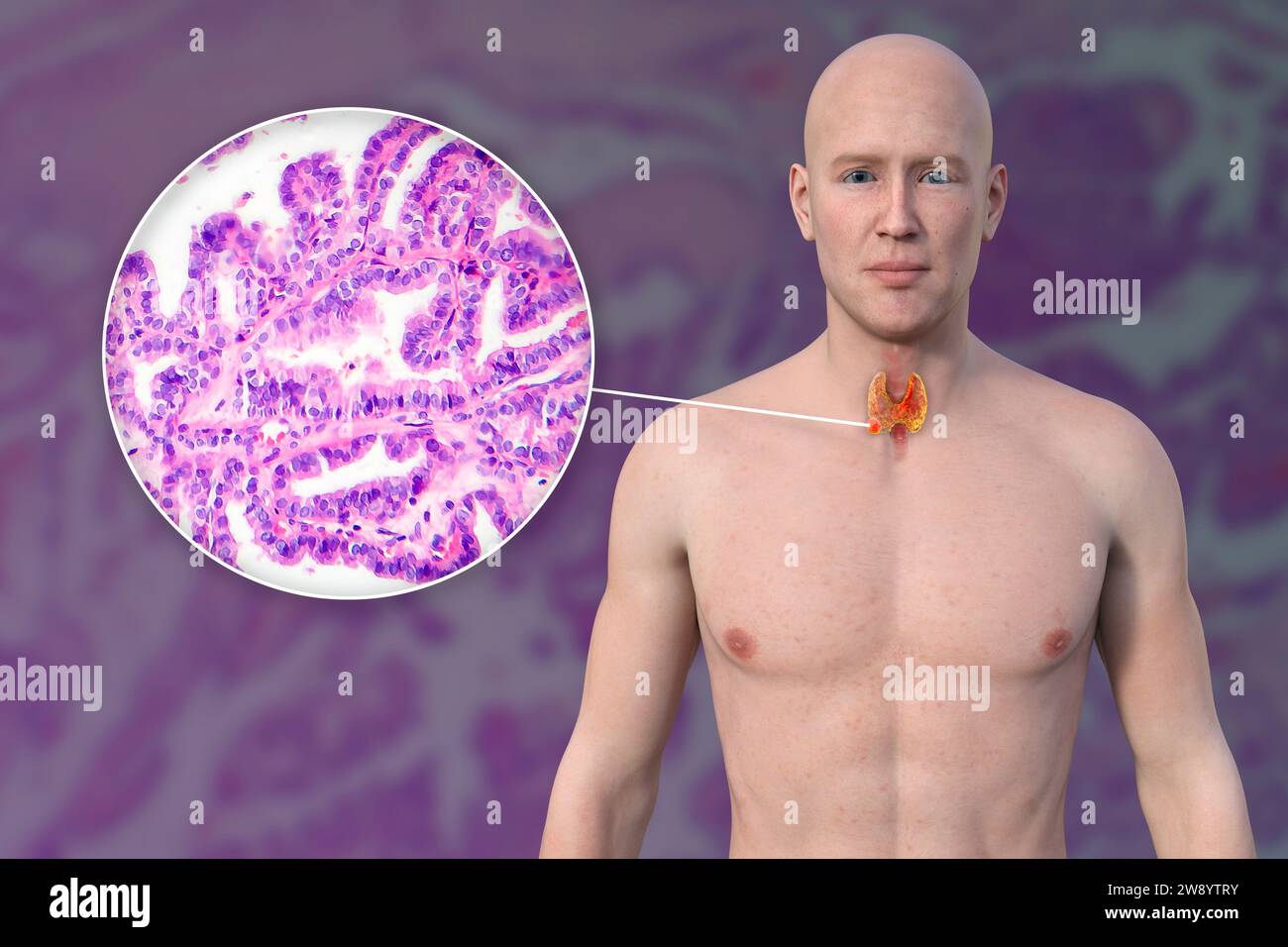 Thyroid cancer, illustration Stock Photo Alamy