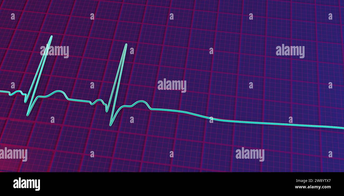 Asystole cardiac arrest, illustration Stock Photo