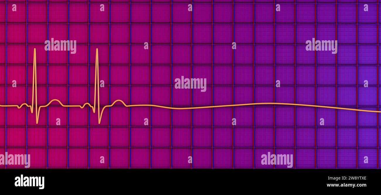 Asystole cardiac arrest, illustration Stock Photo