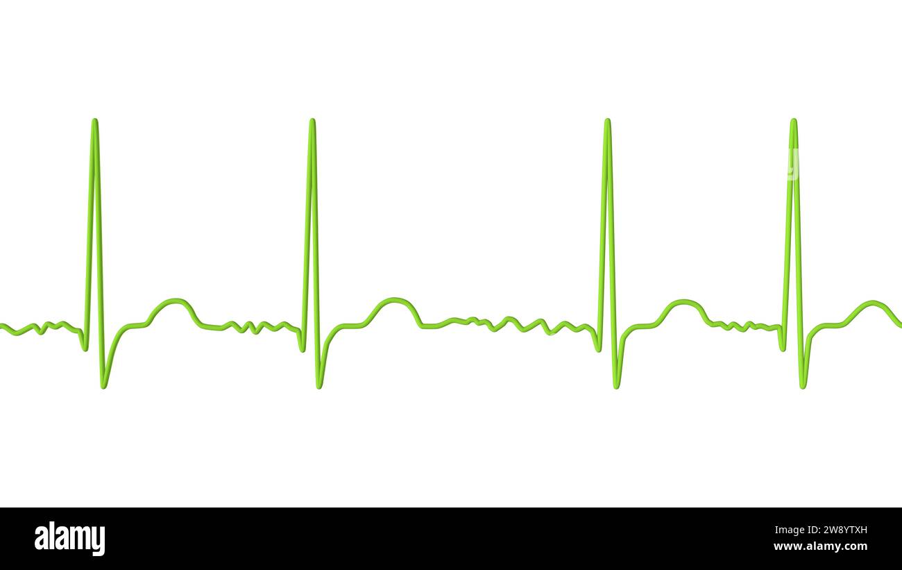 Atrial fibrillation irregular heartbeat rhythm, illustration Stock Photo