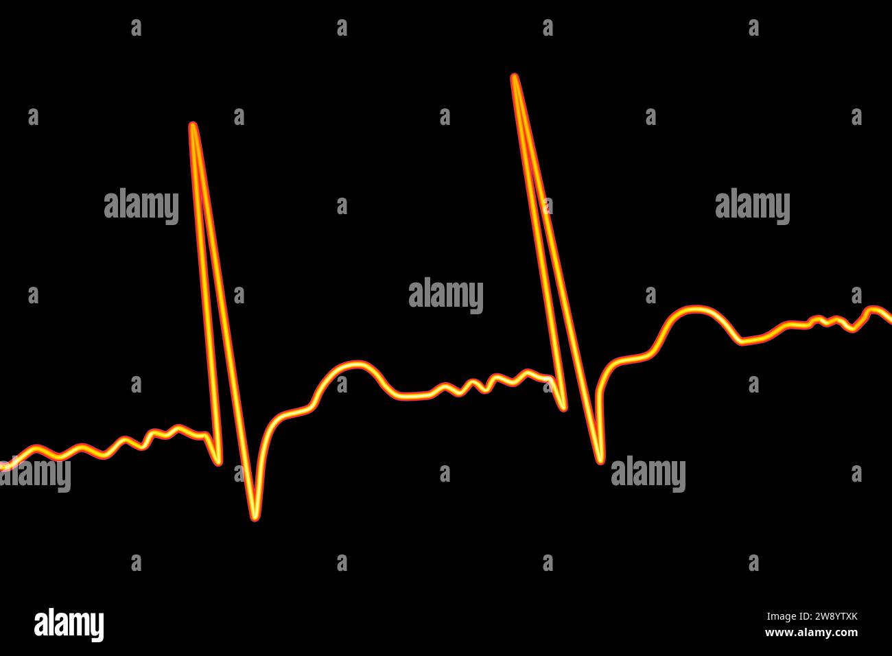 Atrial fibrillation irregular heartbeat rhythm, illustration Stock Photo