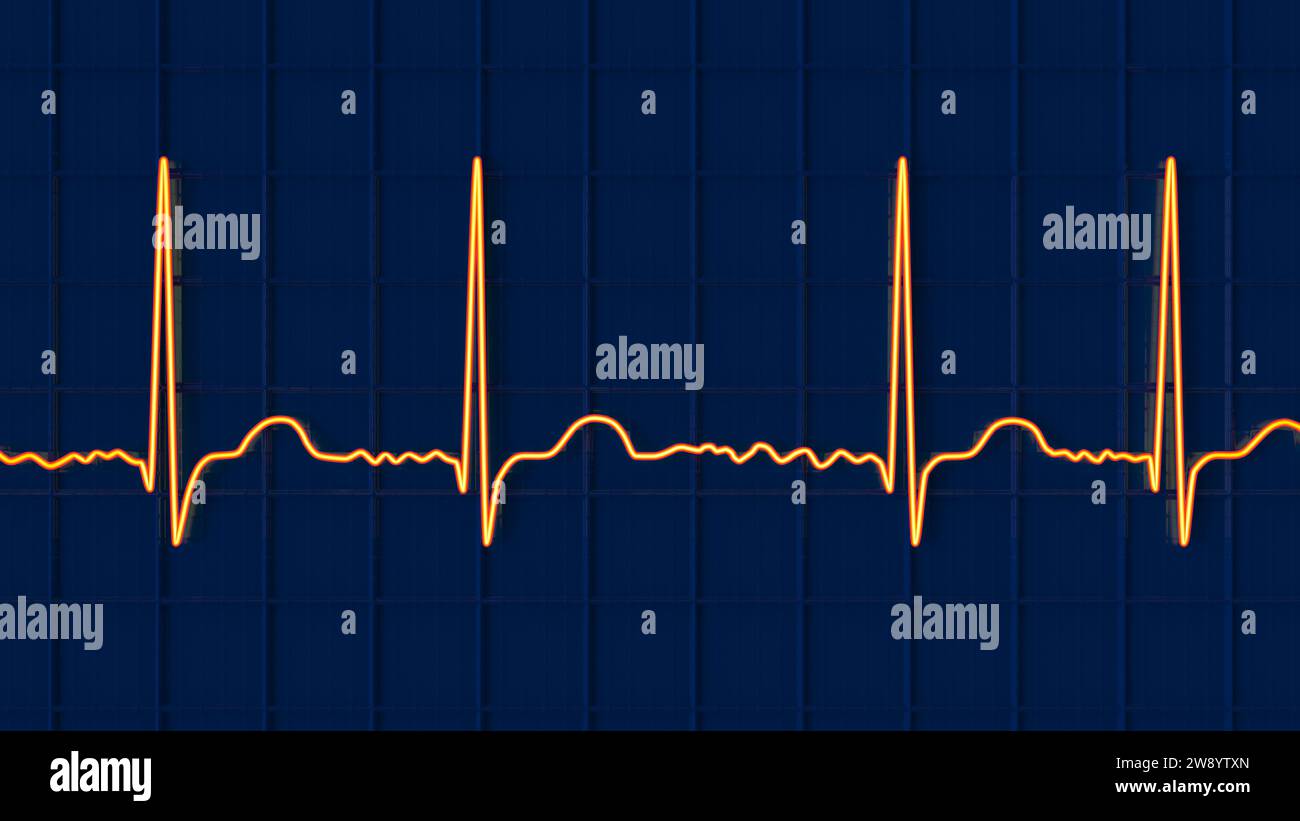 Atrial fibrillation irregular heartbeat rhythm, illustration Stock Photo