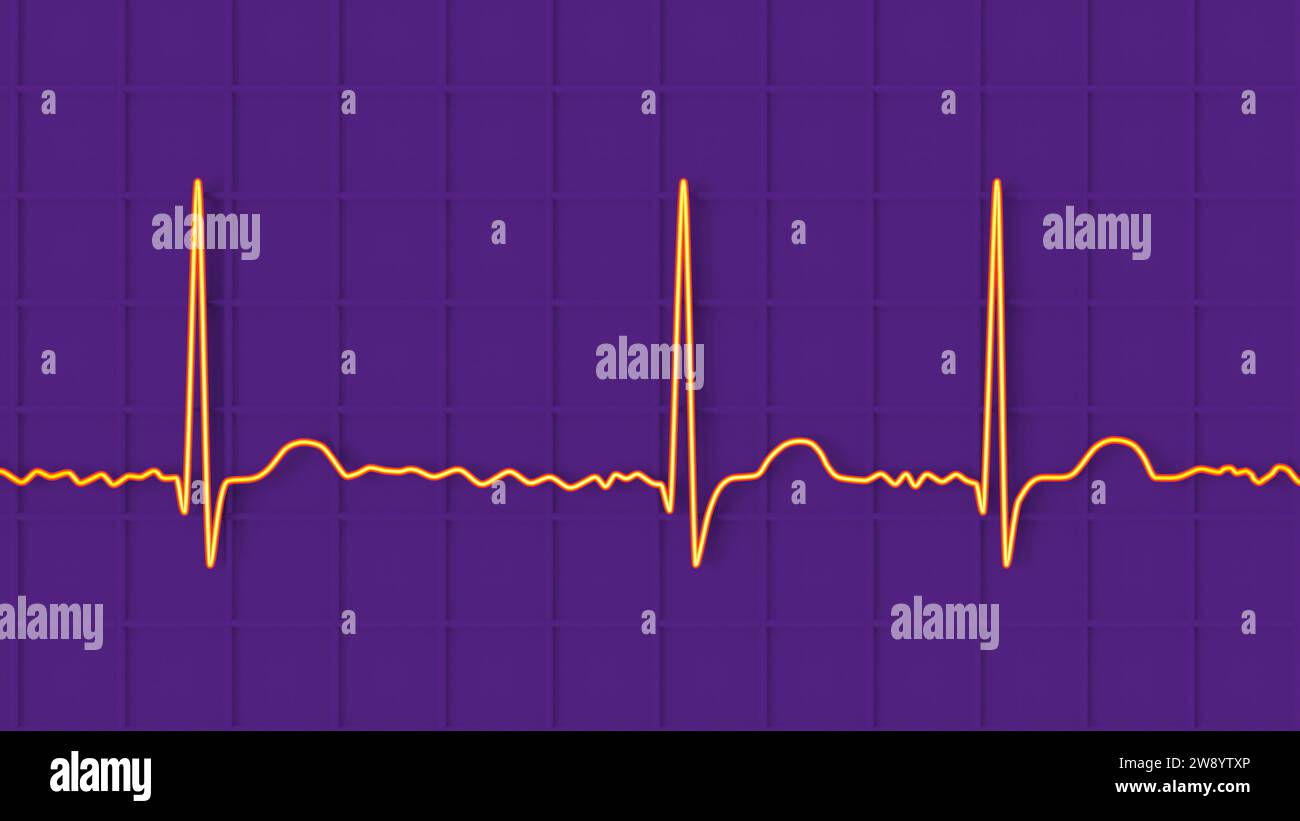 Atrial fibrillation irregular heartbeat rhythm, illustration Stock Photo