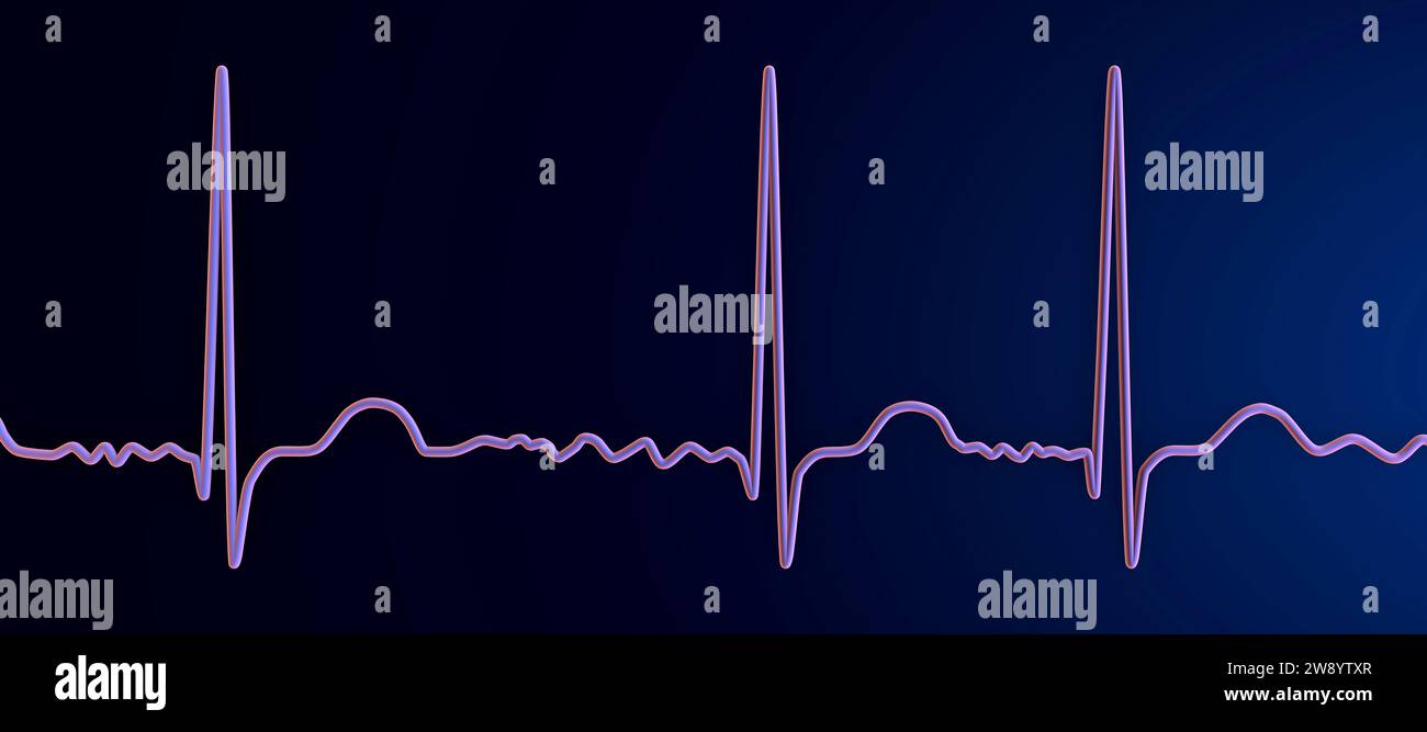 Atrial fibrillation irregular heartbeat rhythm, illustration Stock Photo