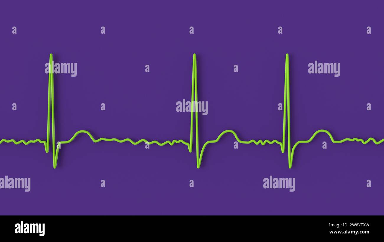 Atrial fibrillation irregular heartbeat rhythm, illustration Stock Photo