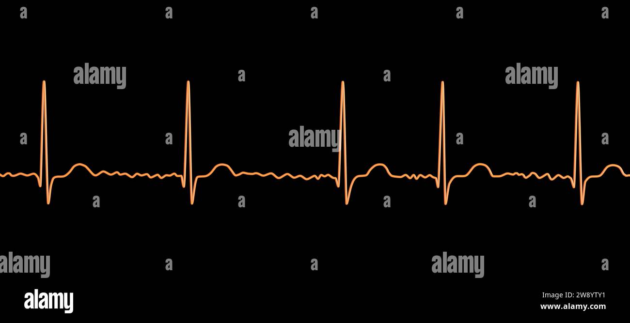 Atrial fibrillation irregular heartbeat rhythm, illustration Stock Photo