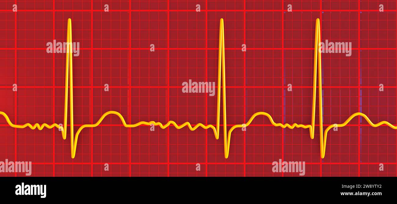 Atrial fibrillation irregular heartbeat rhythm, illustration Stock Photo