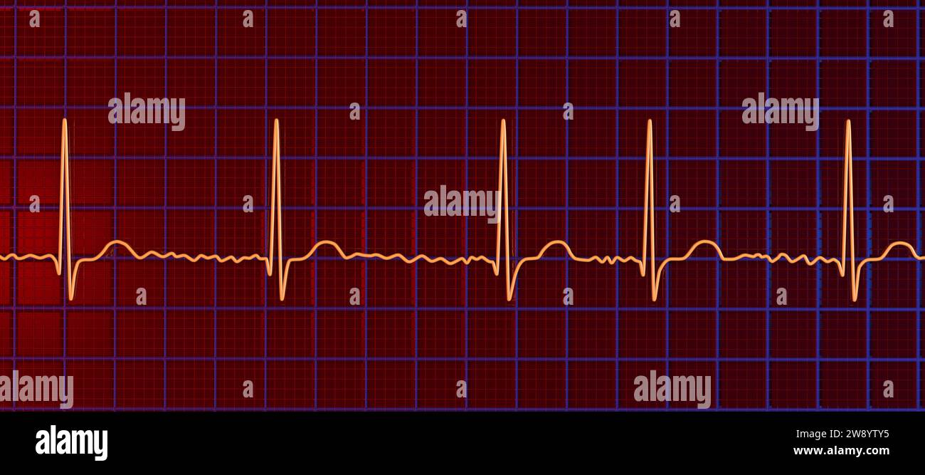 Atrial fibrillation irregular heartbeat rhythm, illustration Stock Photo