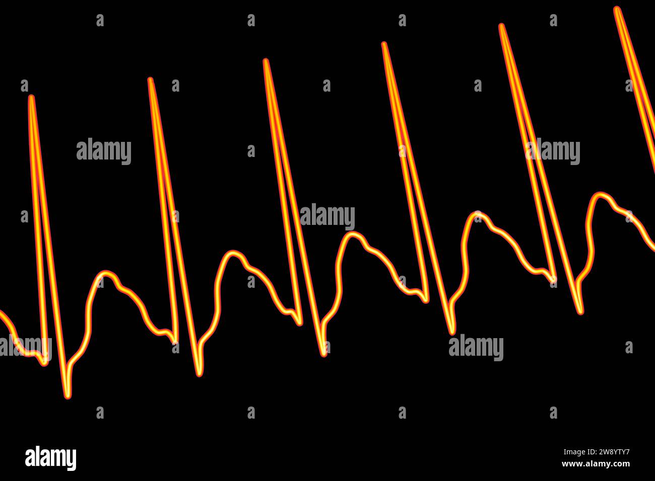 Atrial Flutter Abnormal Heartbeat Rhythm Illustration Stock Photo Alamy atrial-flutter-abnormal-heartbeat-rhythm-illustration-stock-photo-alamy