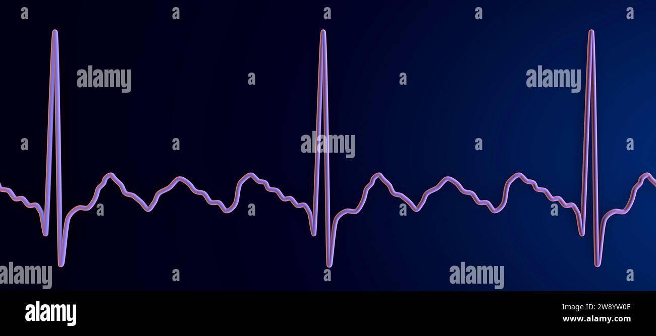 Illustration depicting an atrial flutter abnormal heart rhythm on an