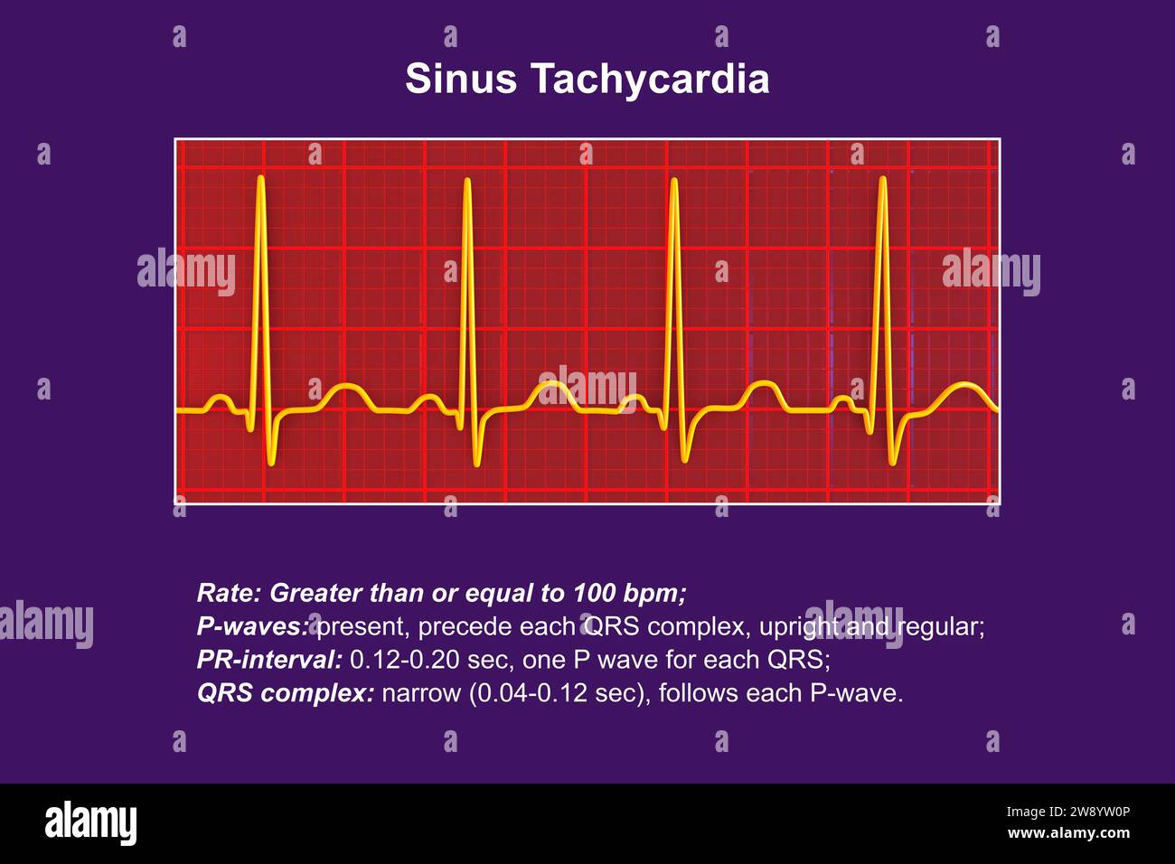 Sinus tachycardia heartbeat rhythm, illustration Stock Photo Alamy