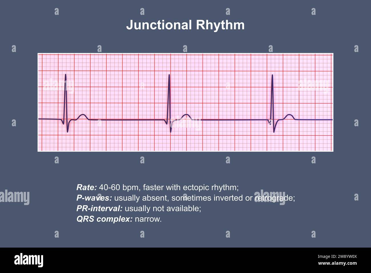 Illustration of an electrocardiogram (ECG) displaying a junctional rhythm of the heartbeat. This