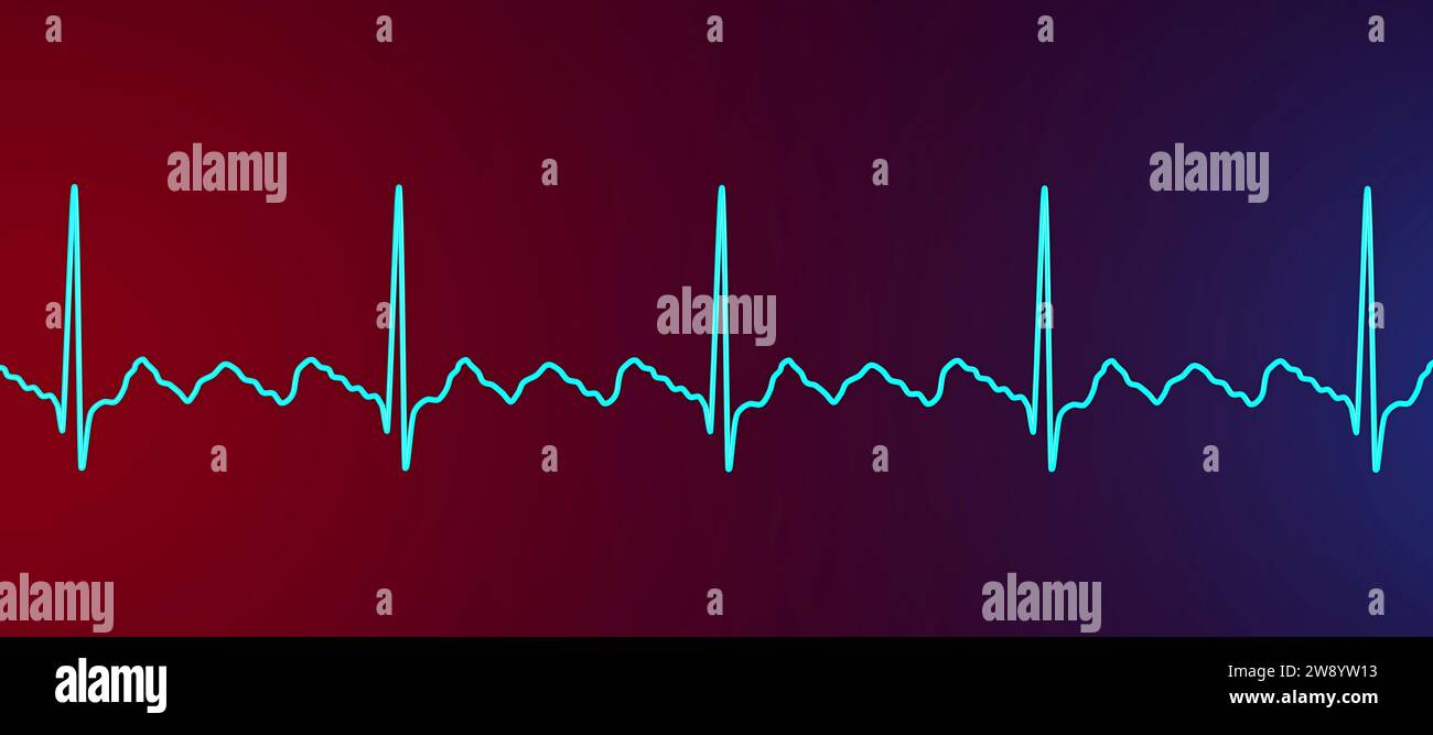Illustration depicting an atrial flutter abnormal heart rhythm on an ...