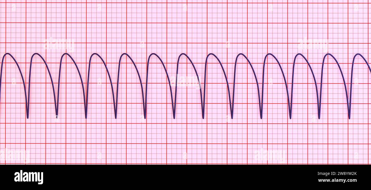 Ventricular tachycardia heartbeat rhythm, illustration Stock Photo