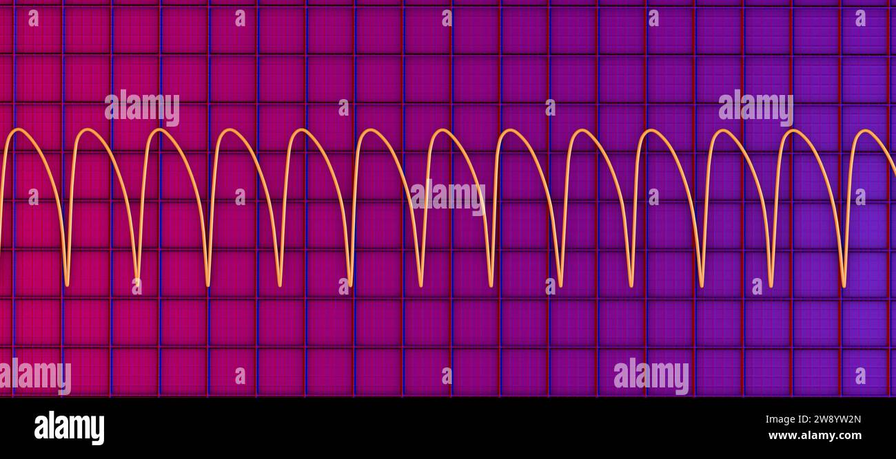 Ventricular tachycardia heartbeat rhythm, illustration Stock Photo