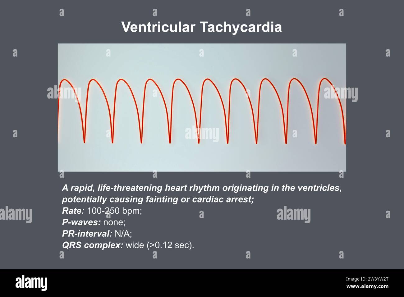 Ventricular tachycardia heartbeat rhythm, illustration Stock Photo