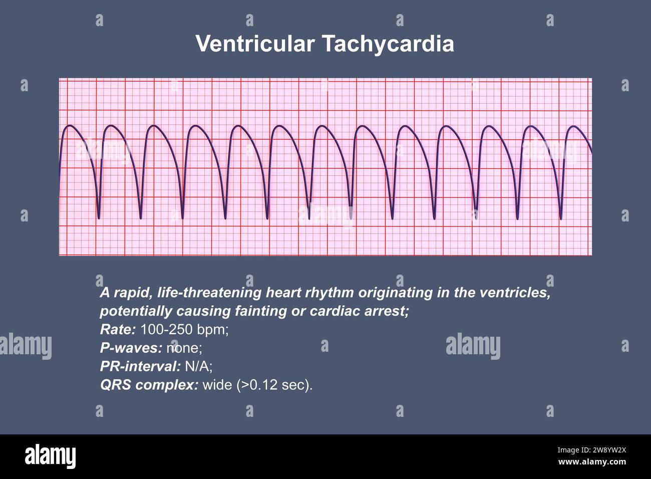 Ventricular tachycardia heartbeat rhythm, illustration Stock Photo