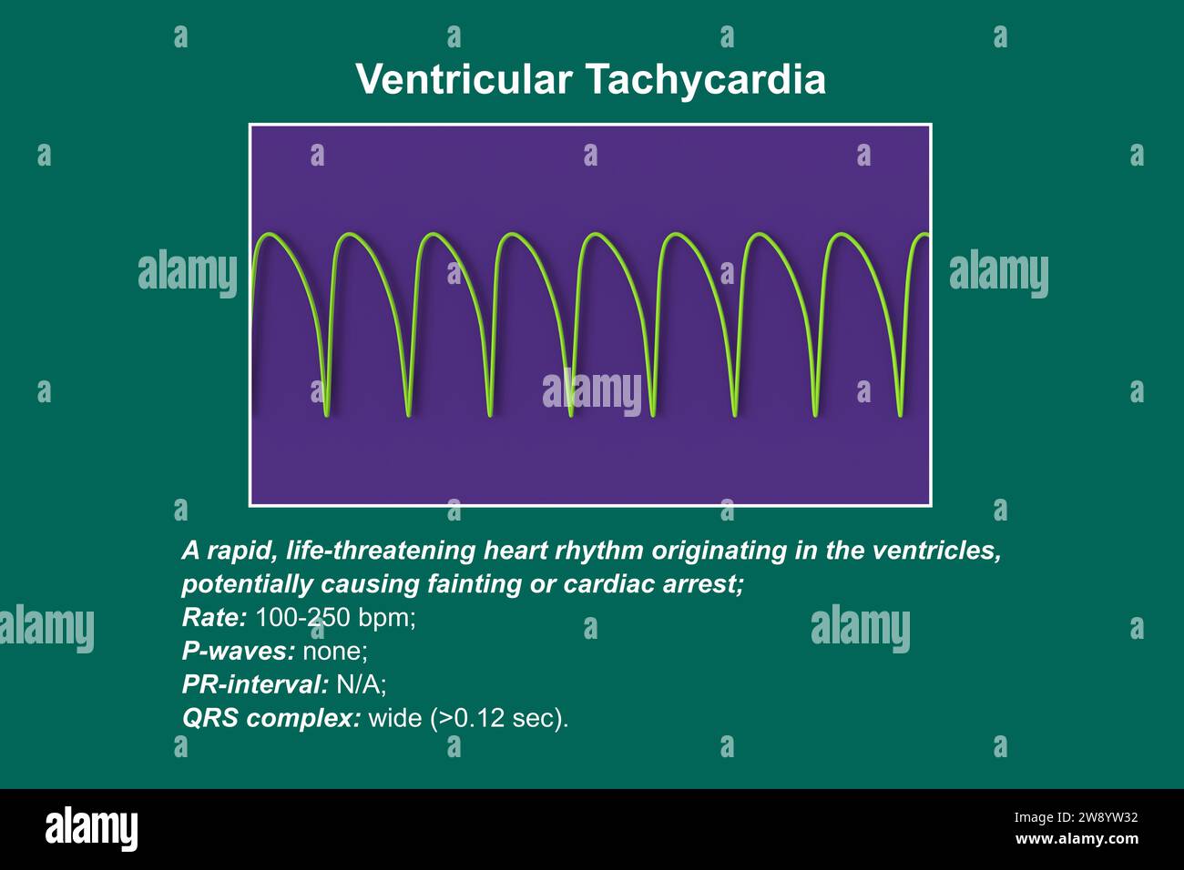 Ventricular tachycardia heartbeat rhythm, illustration Stock Photo