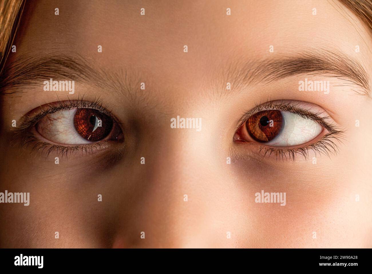 Little patient strabismus, treatment ophthalmic diseases. Strabismus in children causes, treatment concept. Female eyes with strabismus. Hypertropia Stock Photo