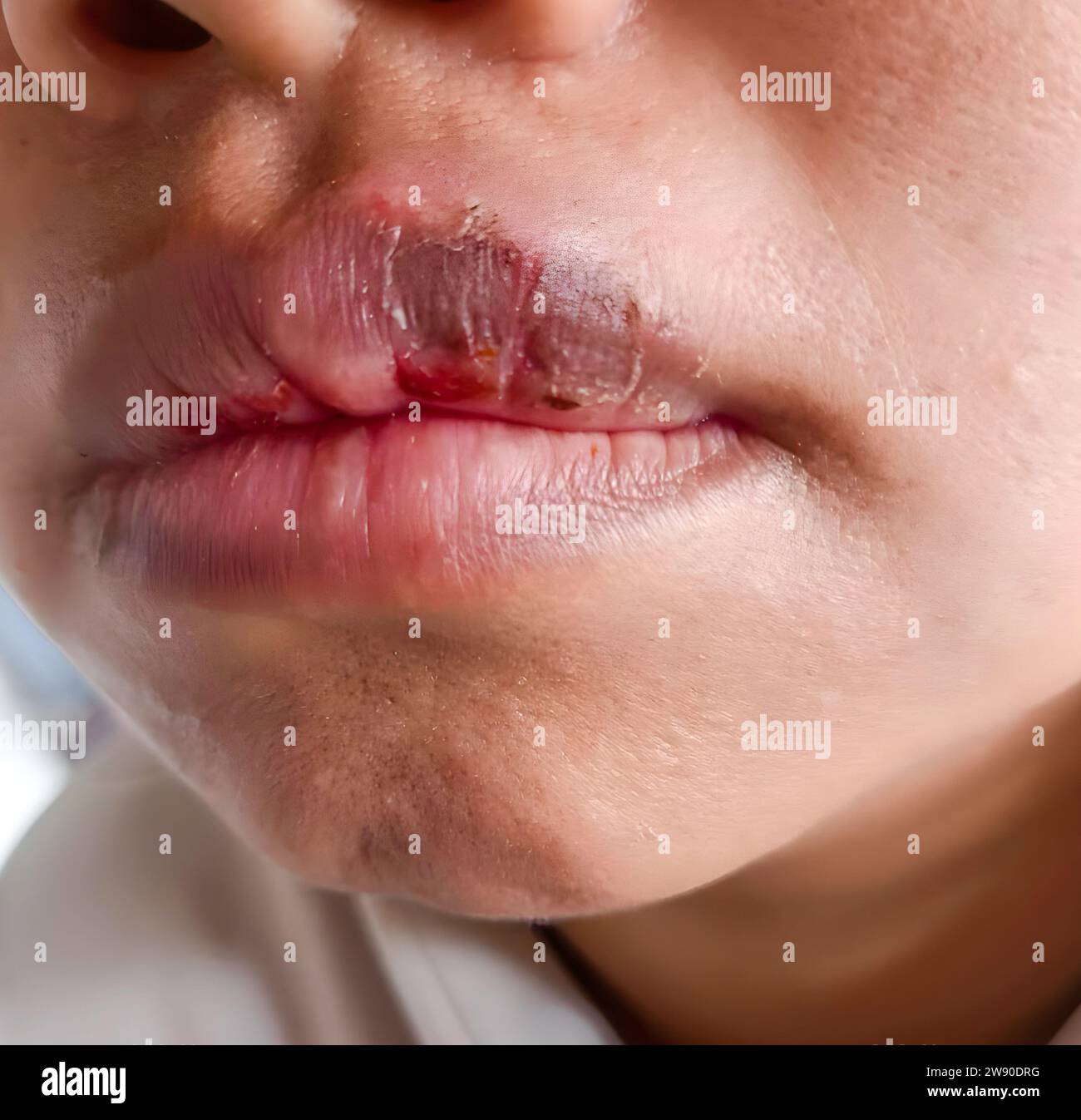 Dry, cracked and dehydrated lips of Asian patient Stock Photo Alamy