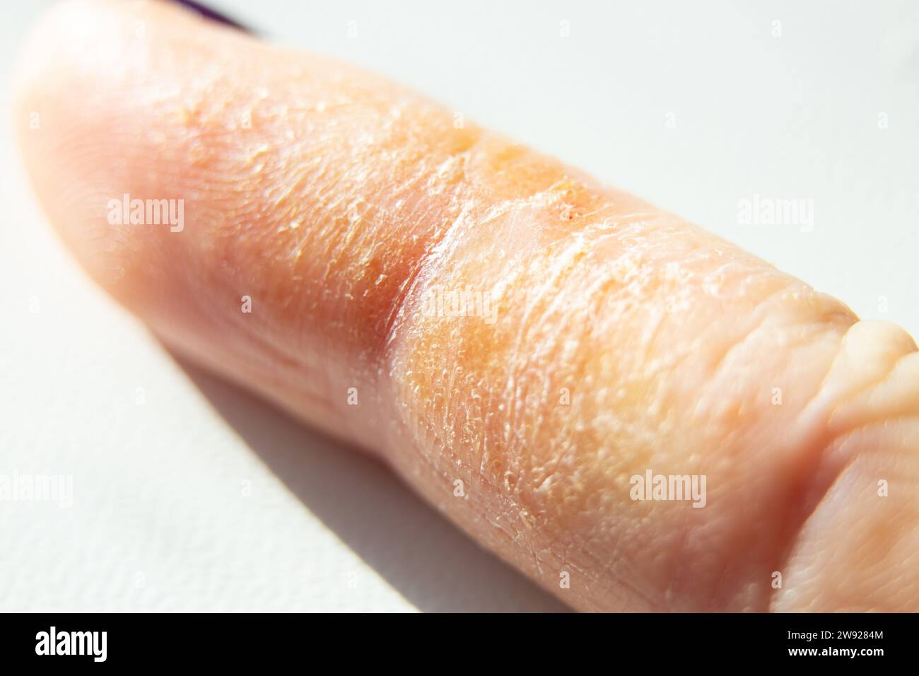 Allergic reaction and rash on finger, skin irritation, dry skin close-up Stock Photo