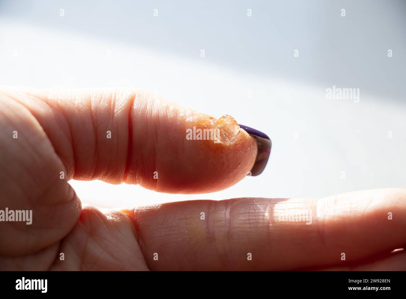 Allergic reaction and rash on the finger and smeared gel for treatment