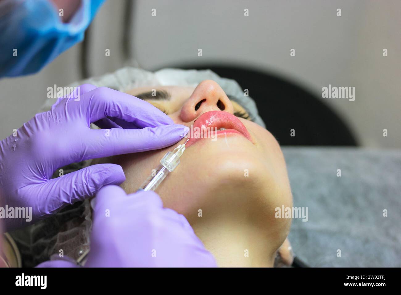 Lip augmentation procedure. A patient woman getting filler injection ...