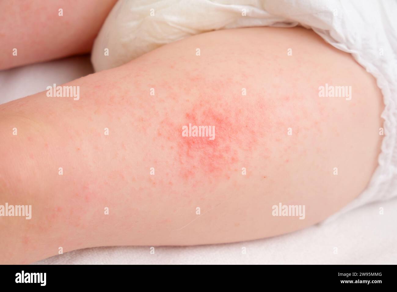 Allergic rash on the legs of the toddler baby boy. Red pimples from allergies on the child's body. Stock Photo