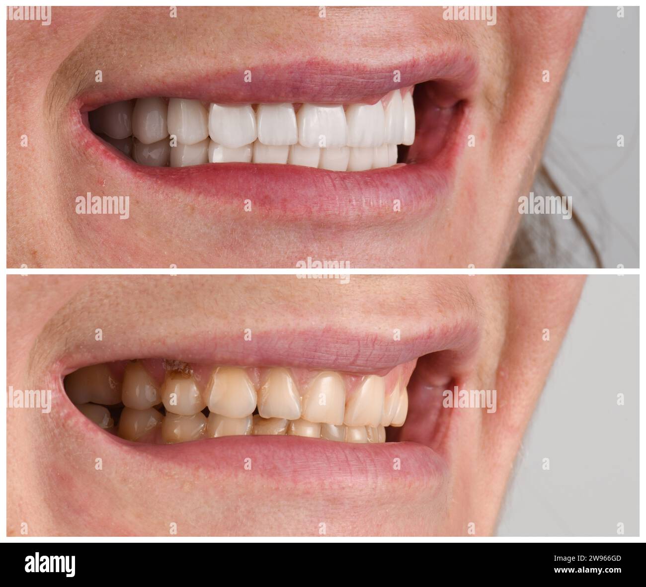 before and after picture of dental veneer and Hollywood smile Stock Photo Alamy