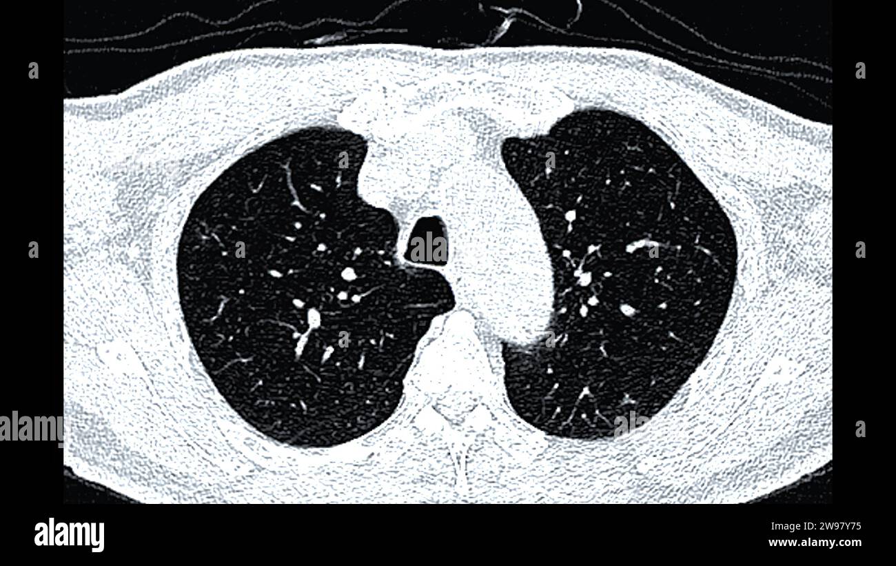 CT scan of Chest or lung axial view for screening lung nodules and lung ...