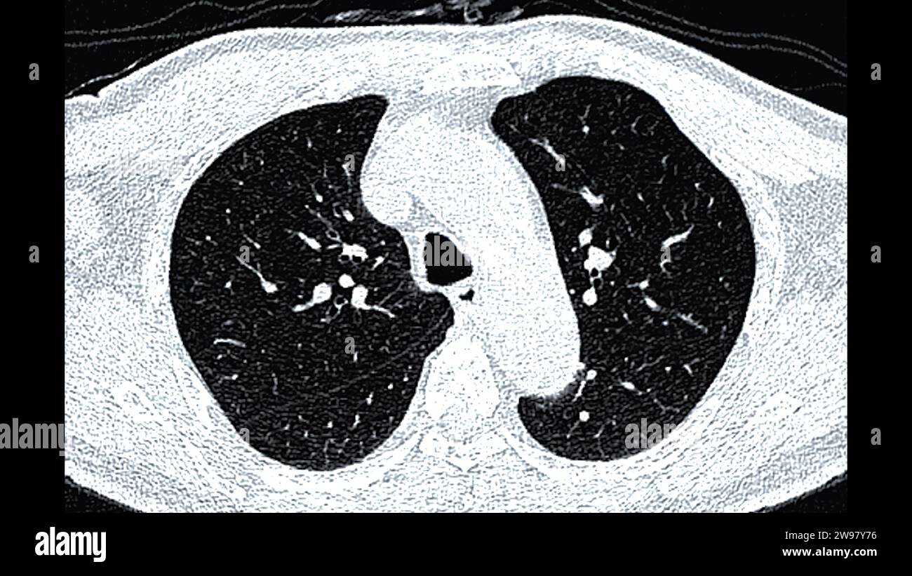 Ct Scan Of Chest Or Lung Axial View For Screening Lung Nodules And Lung Ct Scan Of Chest Or Lung Axial View For Screening Lung Nodules And Lung