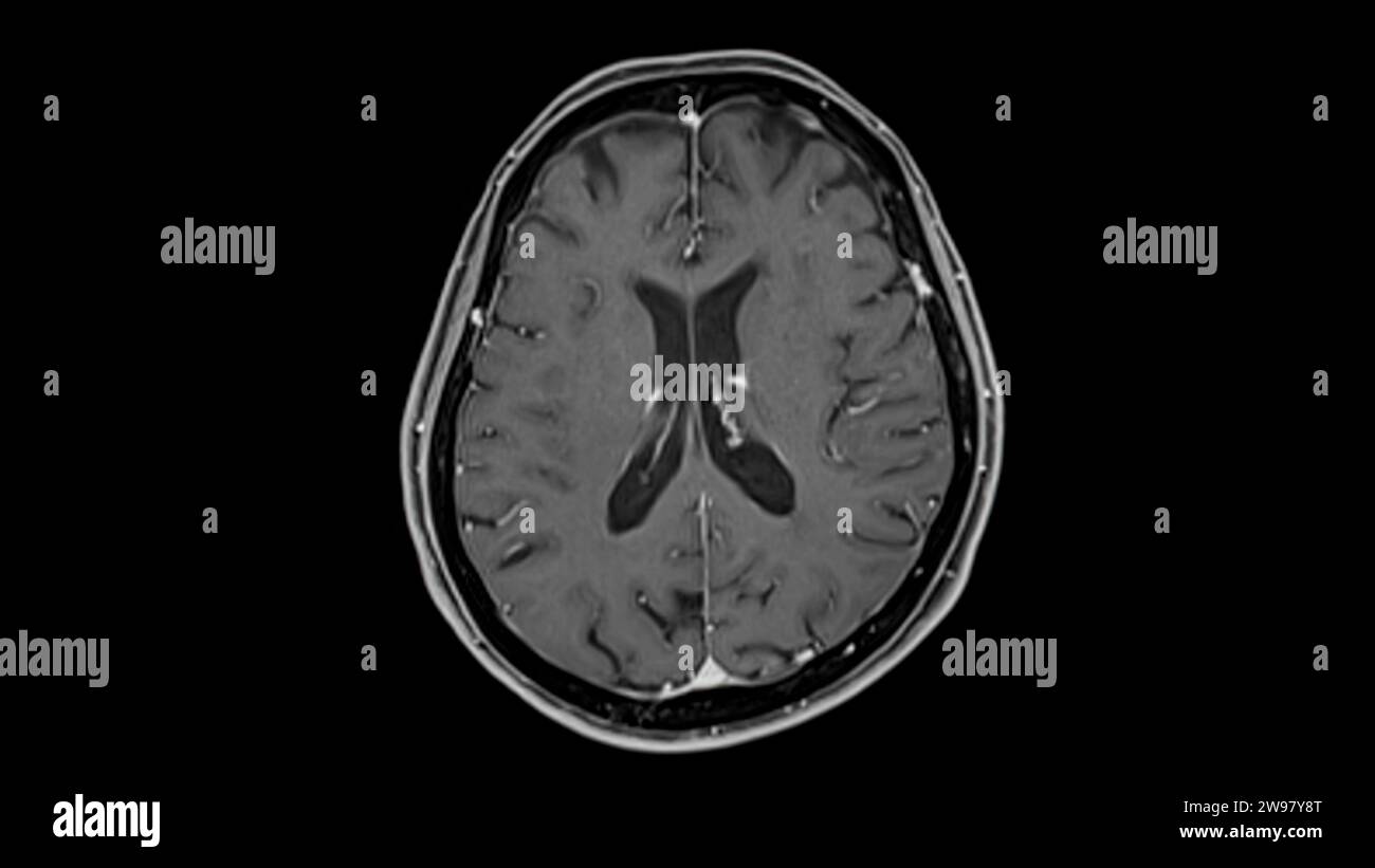 MRI brain scans axial view offer valuable insights into brain anatomy