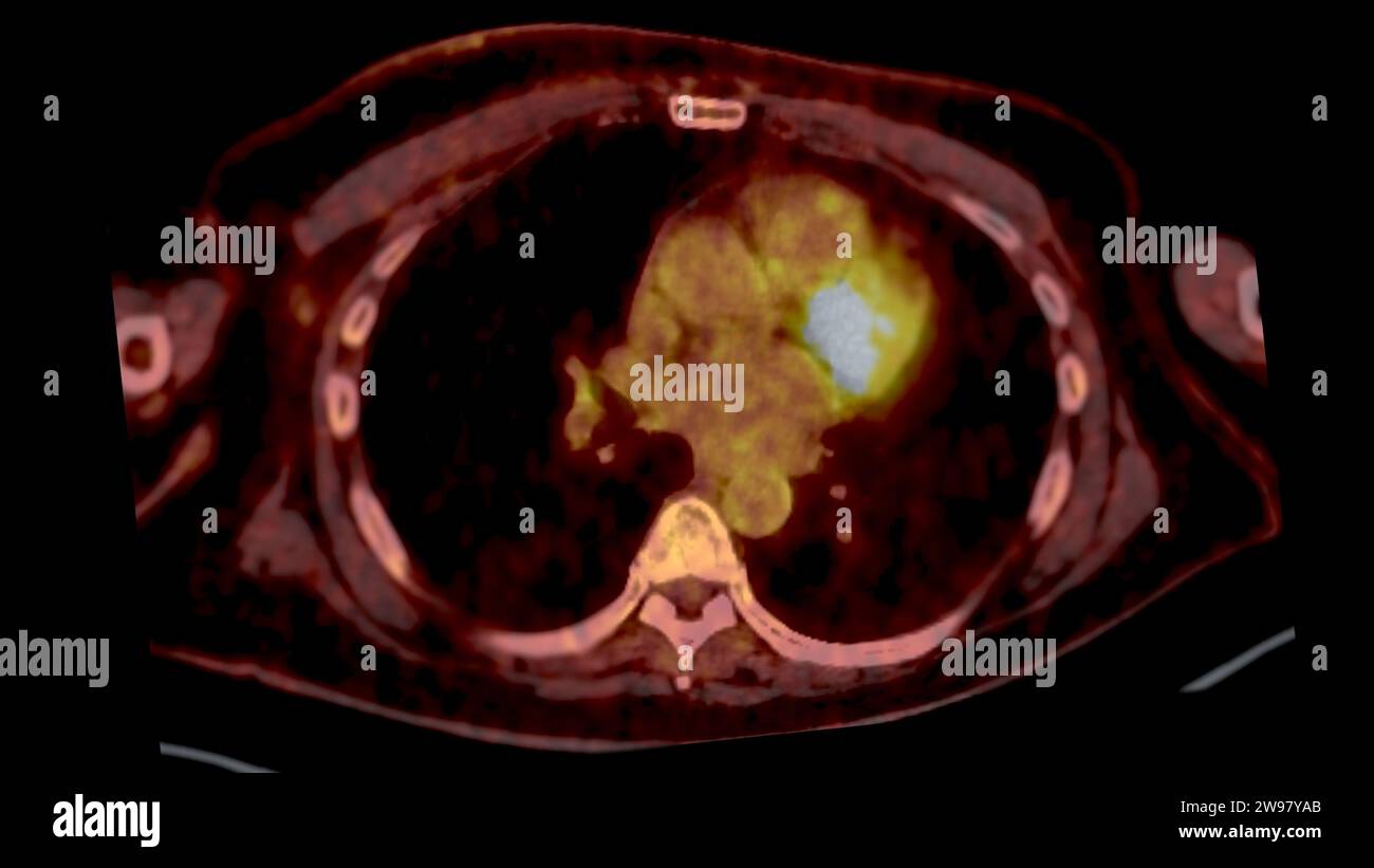 PET CT Scan fusion image It provides detailed images by merging ...