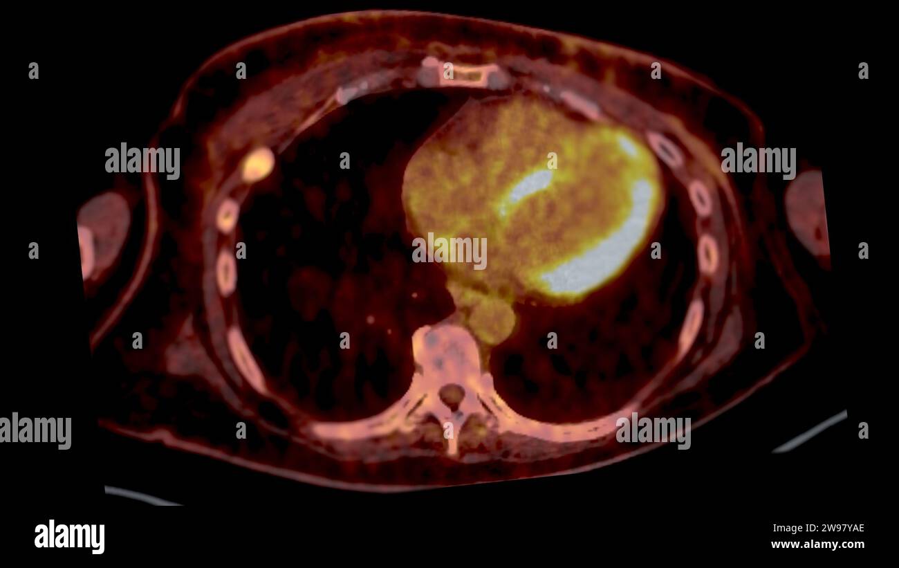 PET CT Scan fusion image It provides detailed images by merging ...