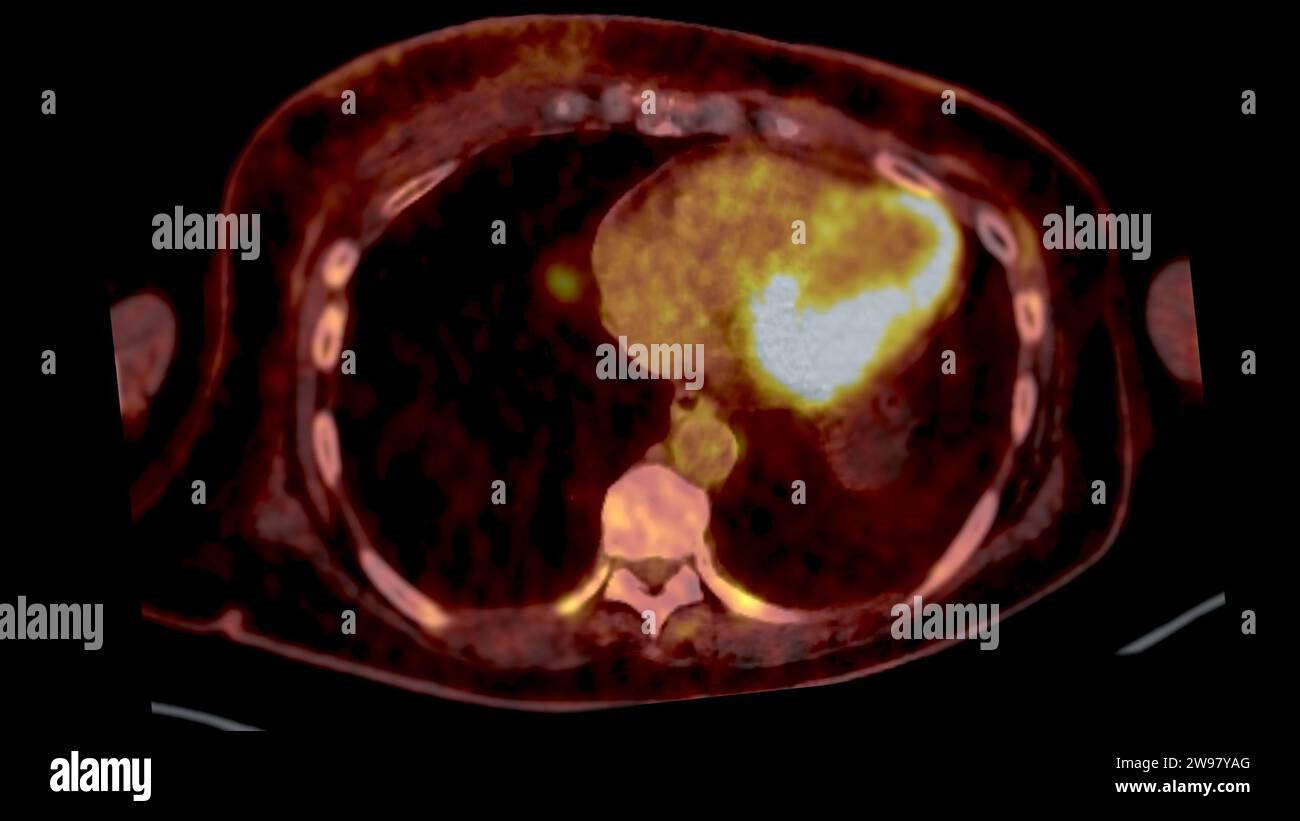 PET CT Scan fusion image It provides detailed images by merging ...