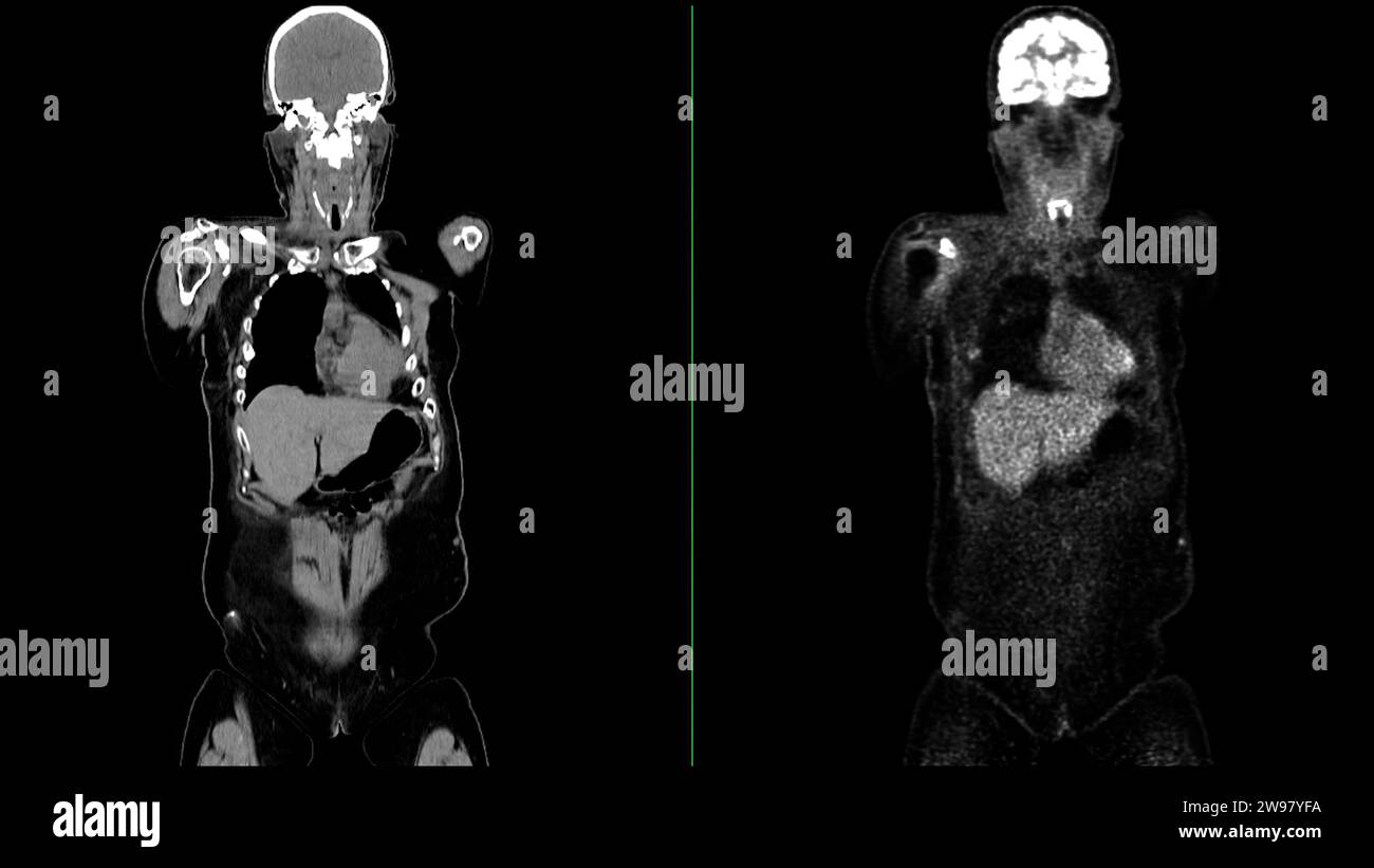 PET CT Scan fusion image It provides detailed images by merging