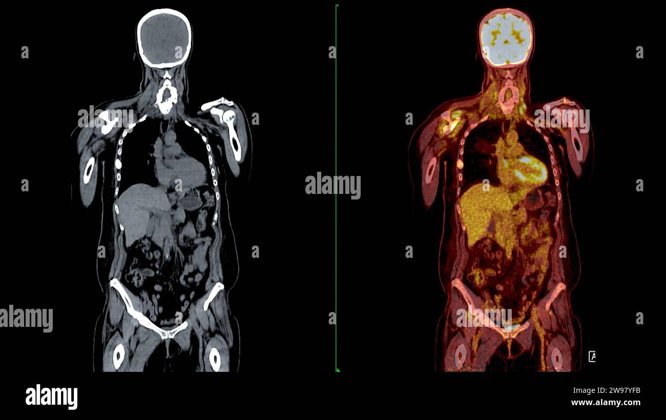 PET CT Scan fusion image It provides detailed images by merging ...
