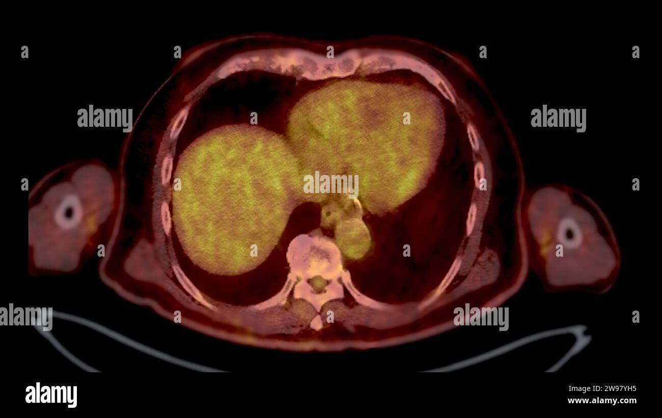 PET CT Scan fusion image It provides detailed images by merging ...