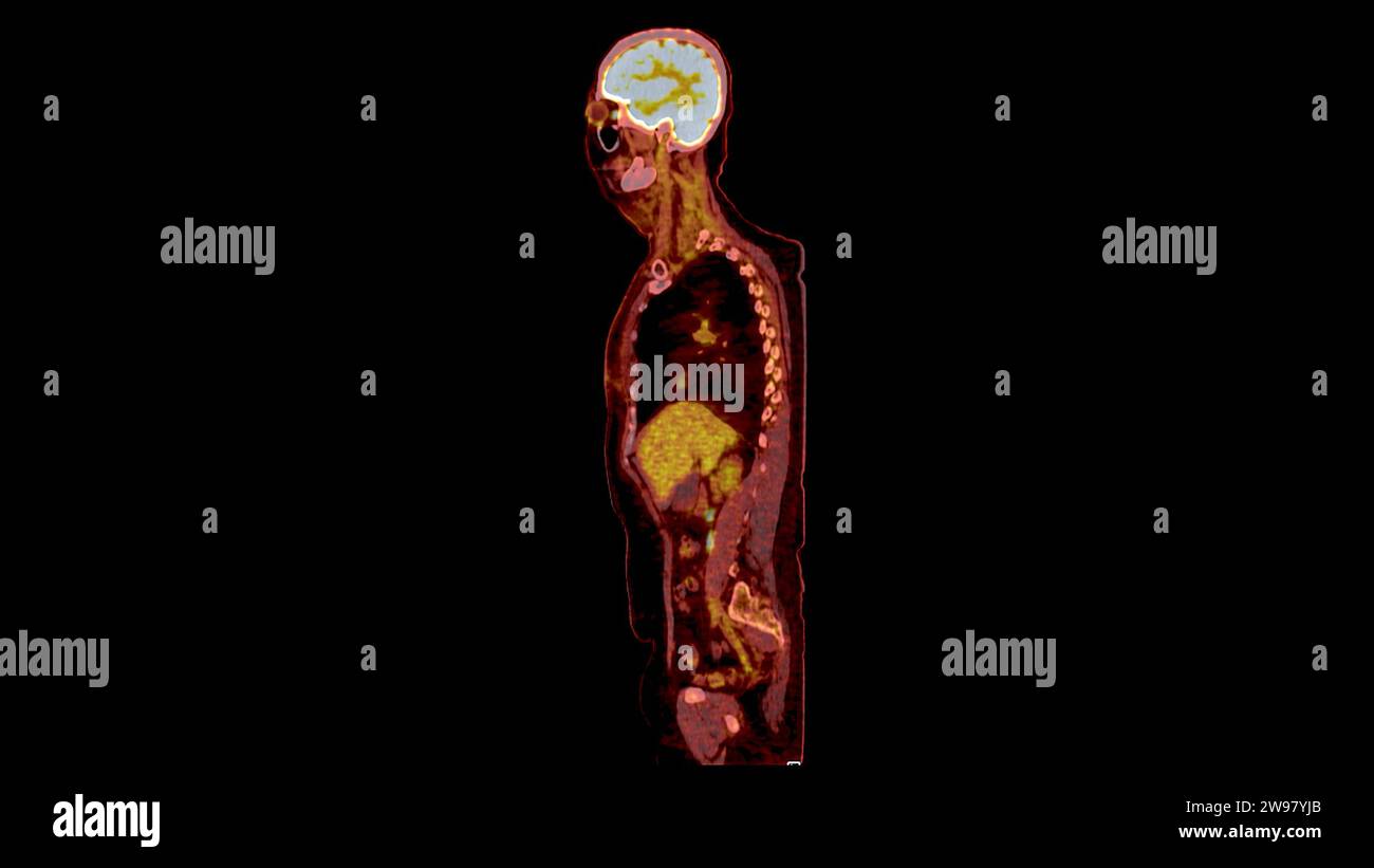PET CT Scan fusion image It provides detailed images by merging ...