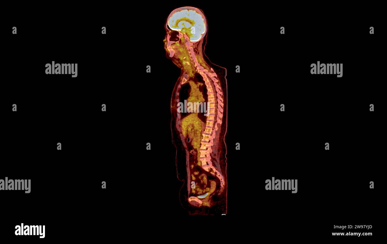 PET CT Scan fusion image It provides detailed images by merging ...